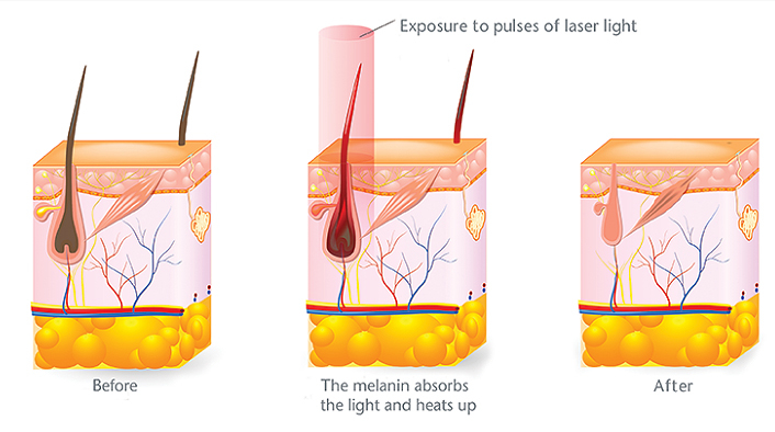 How to distinguish IPL, OPT, DPL