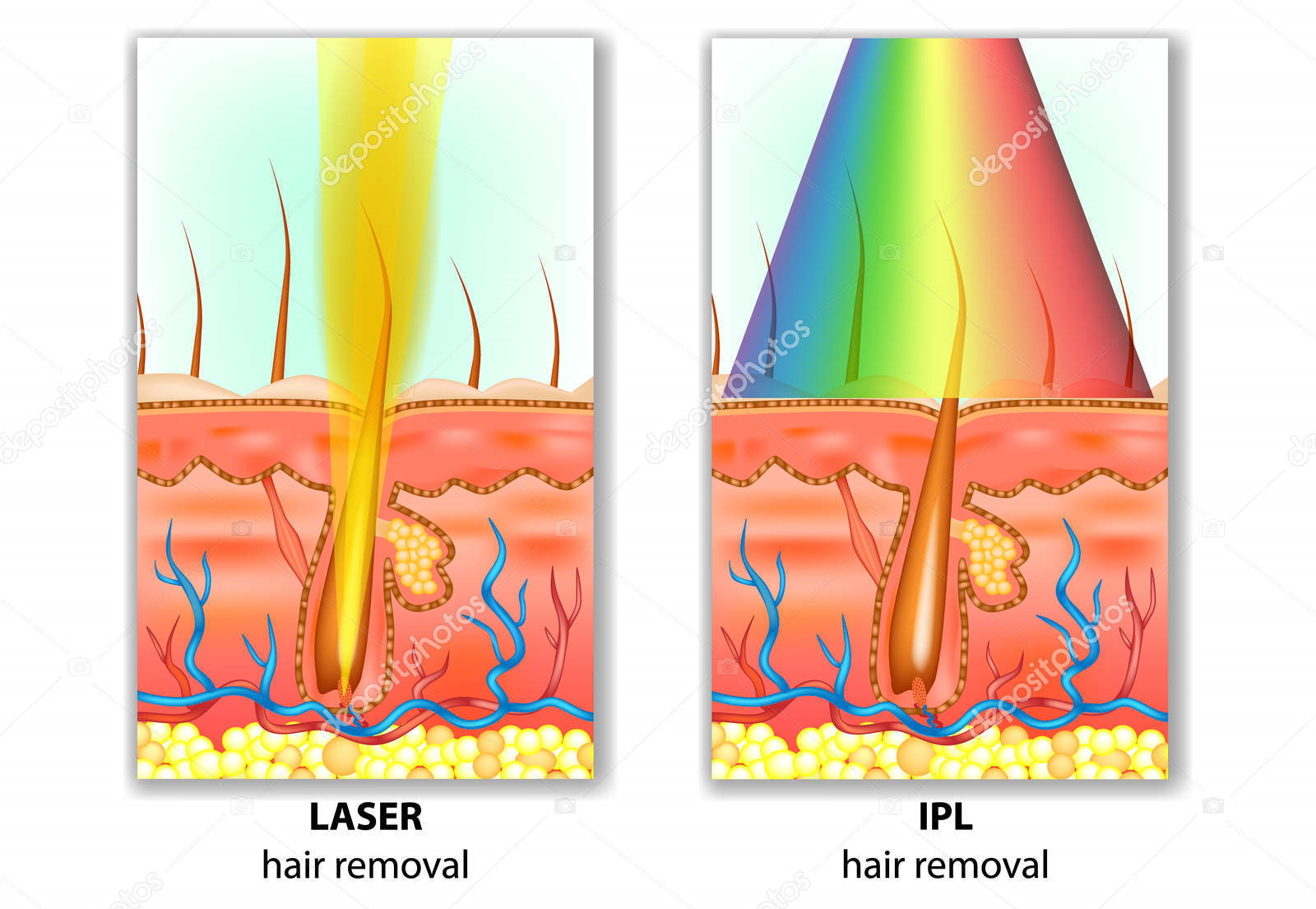 How to distinguish IPL, OPT, DPL