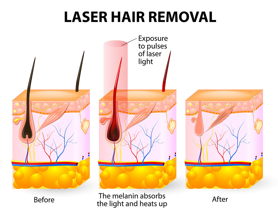 Diode Laser: More Than Skin-Deep Cosmetic Benefits